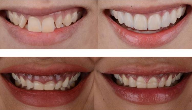 Aligners Before And After